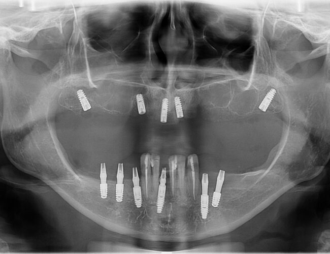 O que o tempo faz com quem perde os dentes